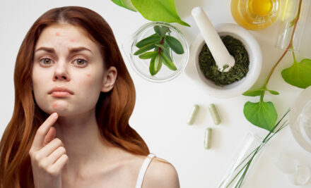 Acné y Ayurveda: causas invisibles y tratamientos naturales