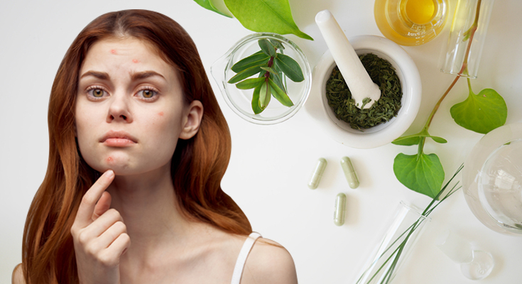Acné y Ayurveda: causas invisibles y tratamientos naturales
