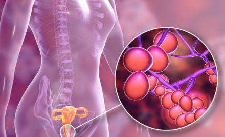 Qué dice el Ayurveda sobre la candidiasis y por qué la digestión ocupa un rol central